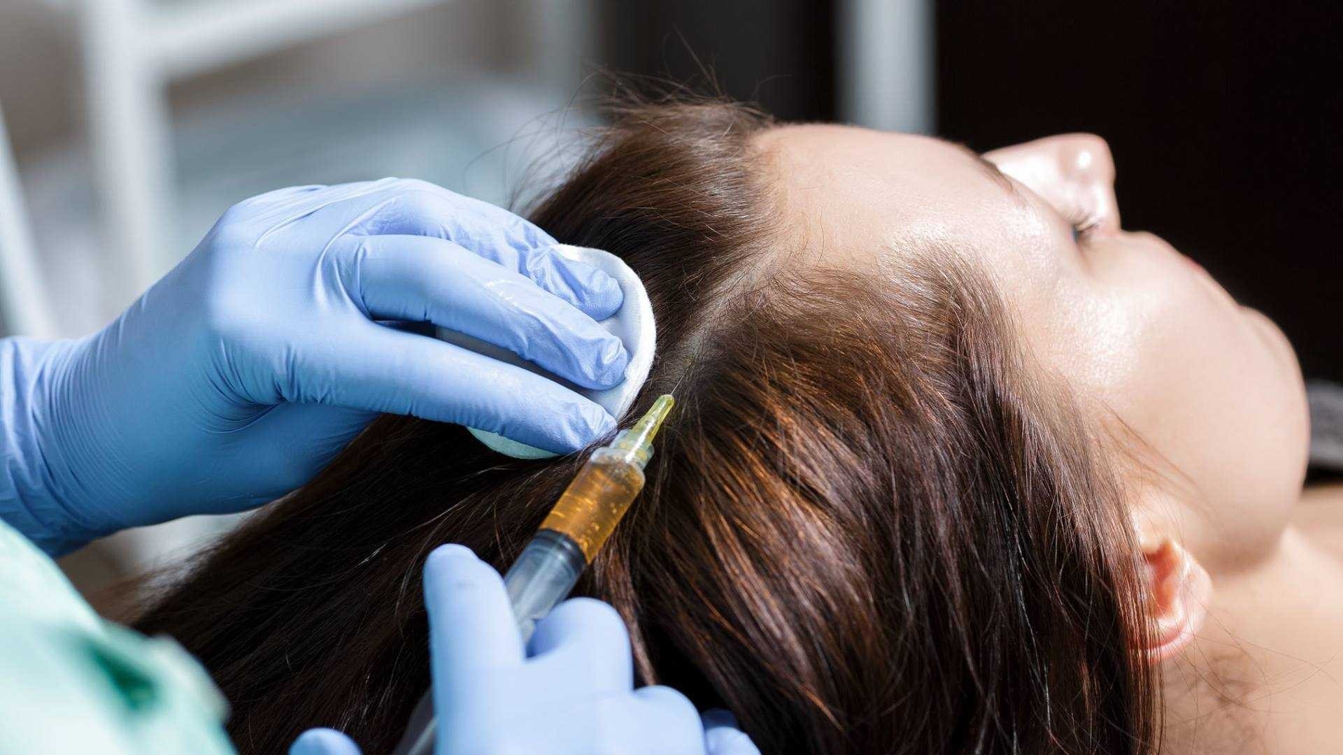 Mezoterapia scalpului  chisinau reduceri oferte
